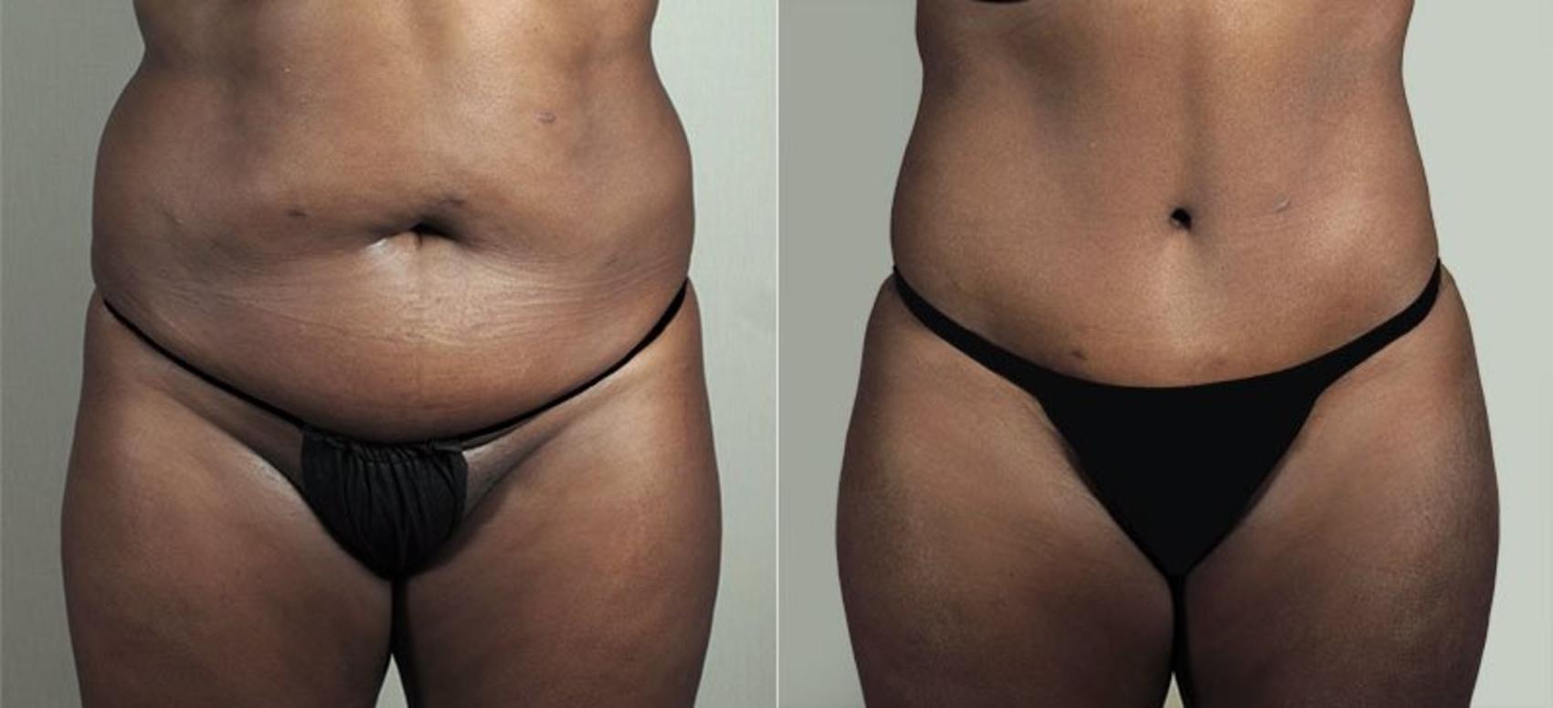 Parker Center for Plastic Surgery tummy tuck result — Paramus, NJ