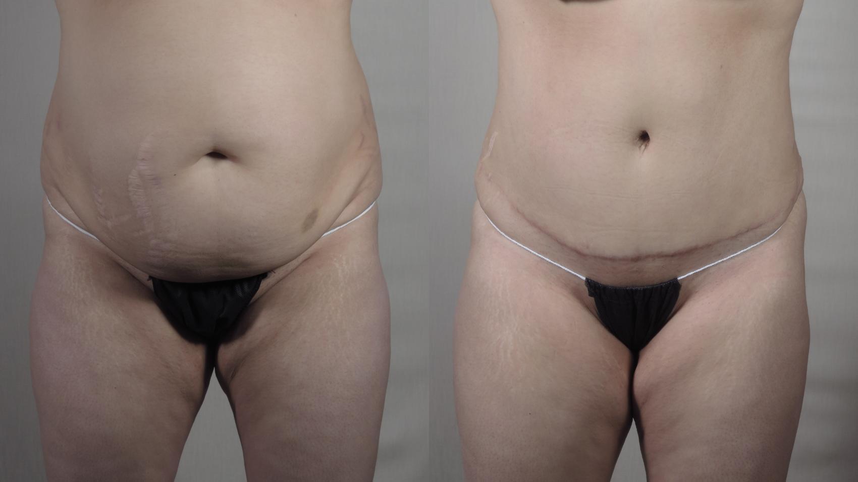 Parker Center for Plastic Surgery tummy tuck result — Paramus, NJ