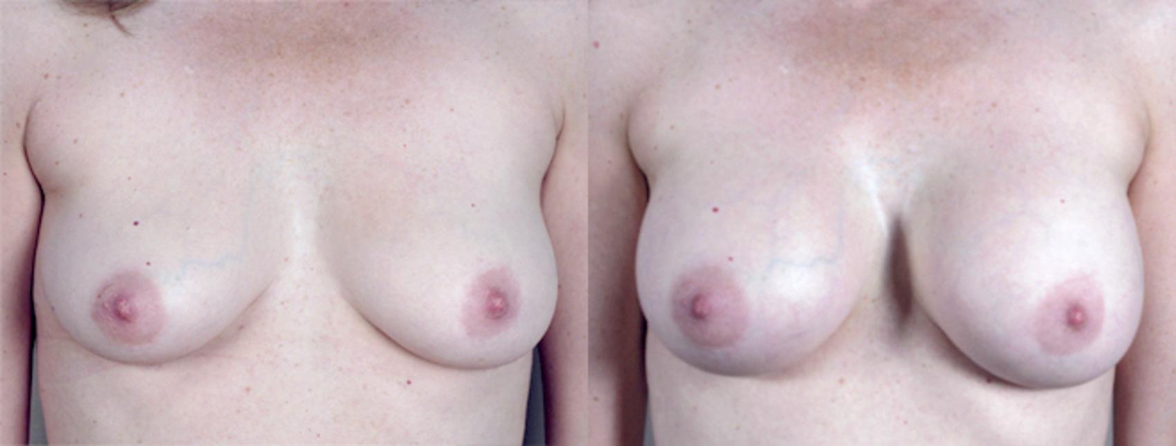 Parker Center for Plastic Surgery breast augmentation result — Paramus, NJ