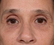 Jonathan Hilton Sherwyn, MD, FACS eyelid lift after — New York, NY