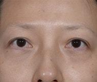 Jonathan Hilton Sherwyn, MD, FACS eyelid lift after — New York, NY