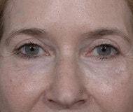 Jonathan Hilton Sherwyn, MD, FACS eyelid lift after — New York, NY