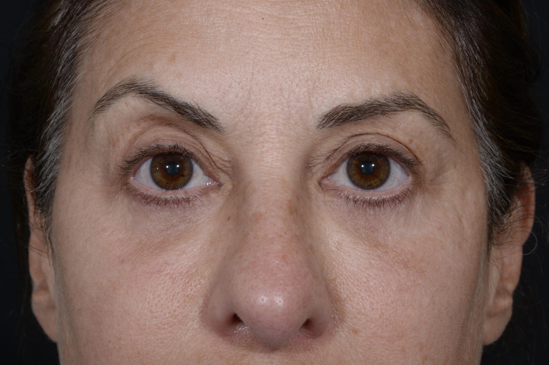 Jonathan Hilton Sherwyn, MD, FACS eyelid lift after — New York, NY