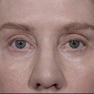 Jonathan Hilton Sherwyn, MD, FACS eyelid lift after — New York, NY