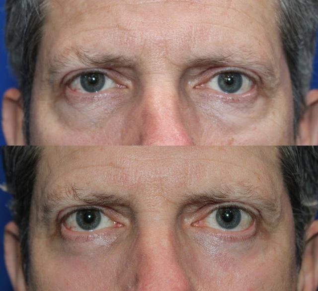 Blepharoplasty result at Kyle Cox, MD in Boulder, CO