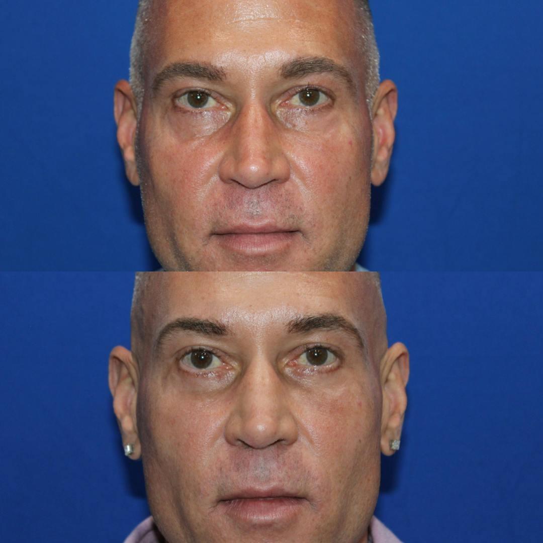 Kyle Cox, MD eyelid lift result — Boulder, CO