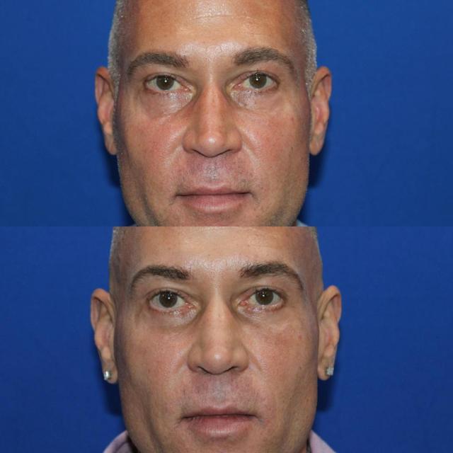 Blepharoplasty result at Kyle Cox, MD in Boulder, CO