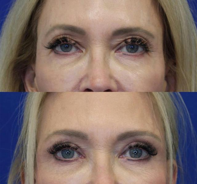 Blepharoplasty result at Kyle Cox, MD in Boulder, CO
