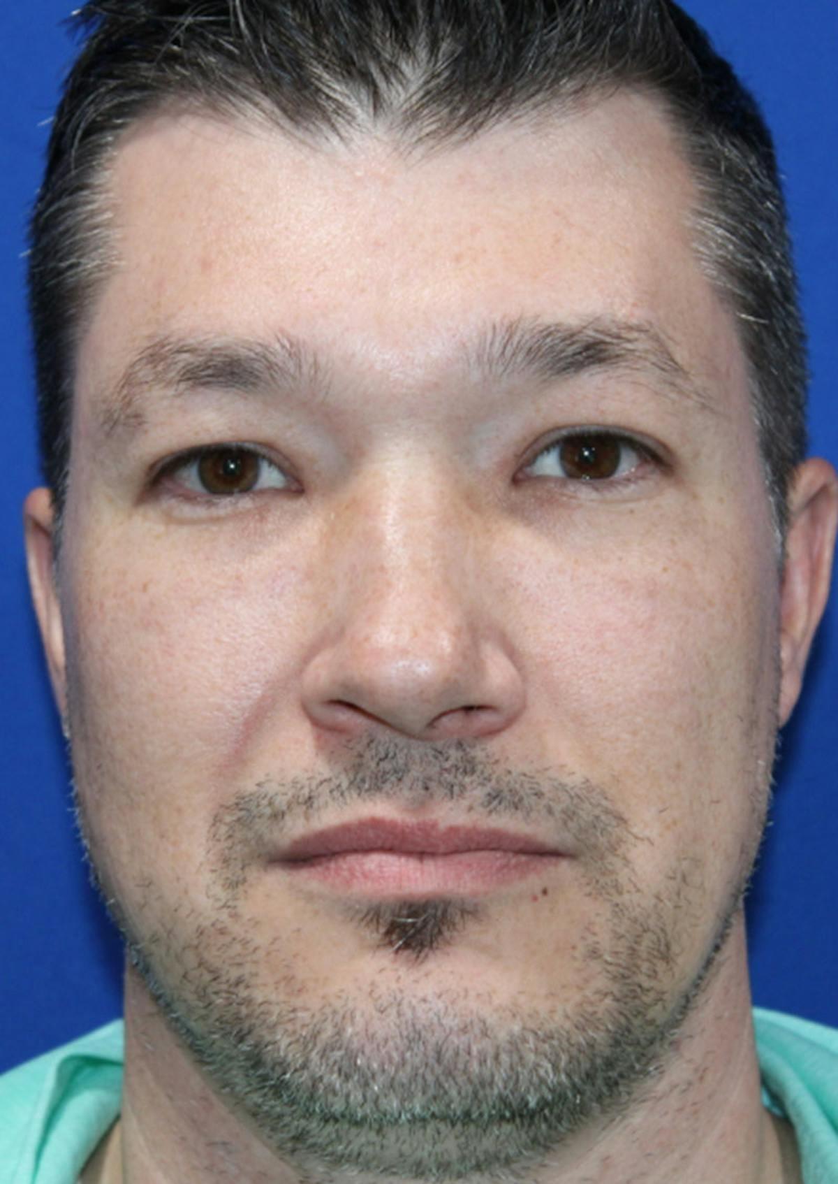Kyle Cox, MD under-eye filler after — Boulder, CO
