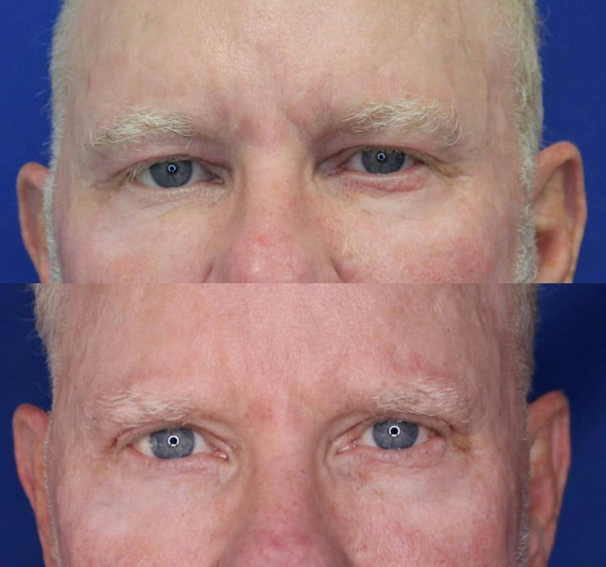 Kyle Cox, MD eyelid lift result — Boulder, CO