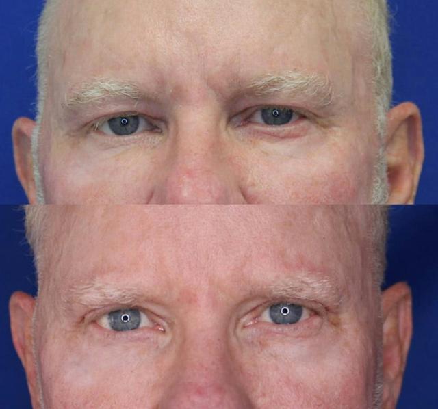 Blepharoplasty result at Kyle Cox, MD in Boulder, CO