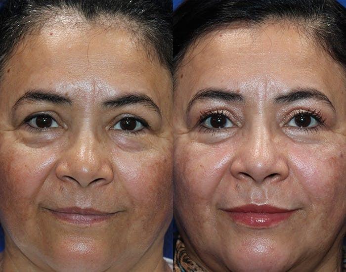 Kyle Cox, MD eyelid lift result — Boulder, CO