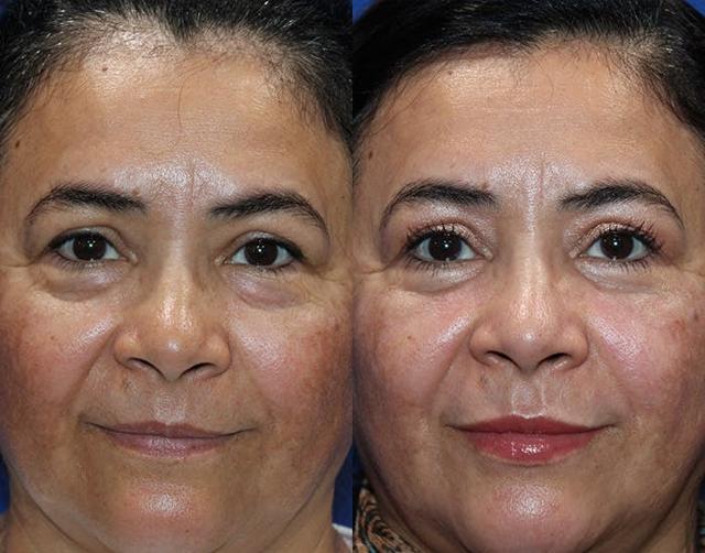Blepharoplasty result at Kyle Cox, MD in Boulder, CO