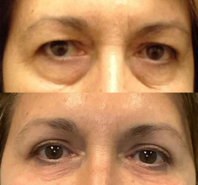 Blepharoplasty result at Kyle Cox, MD in Boulder, CO
