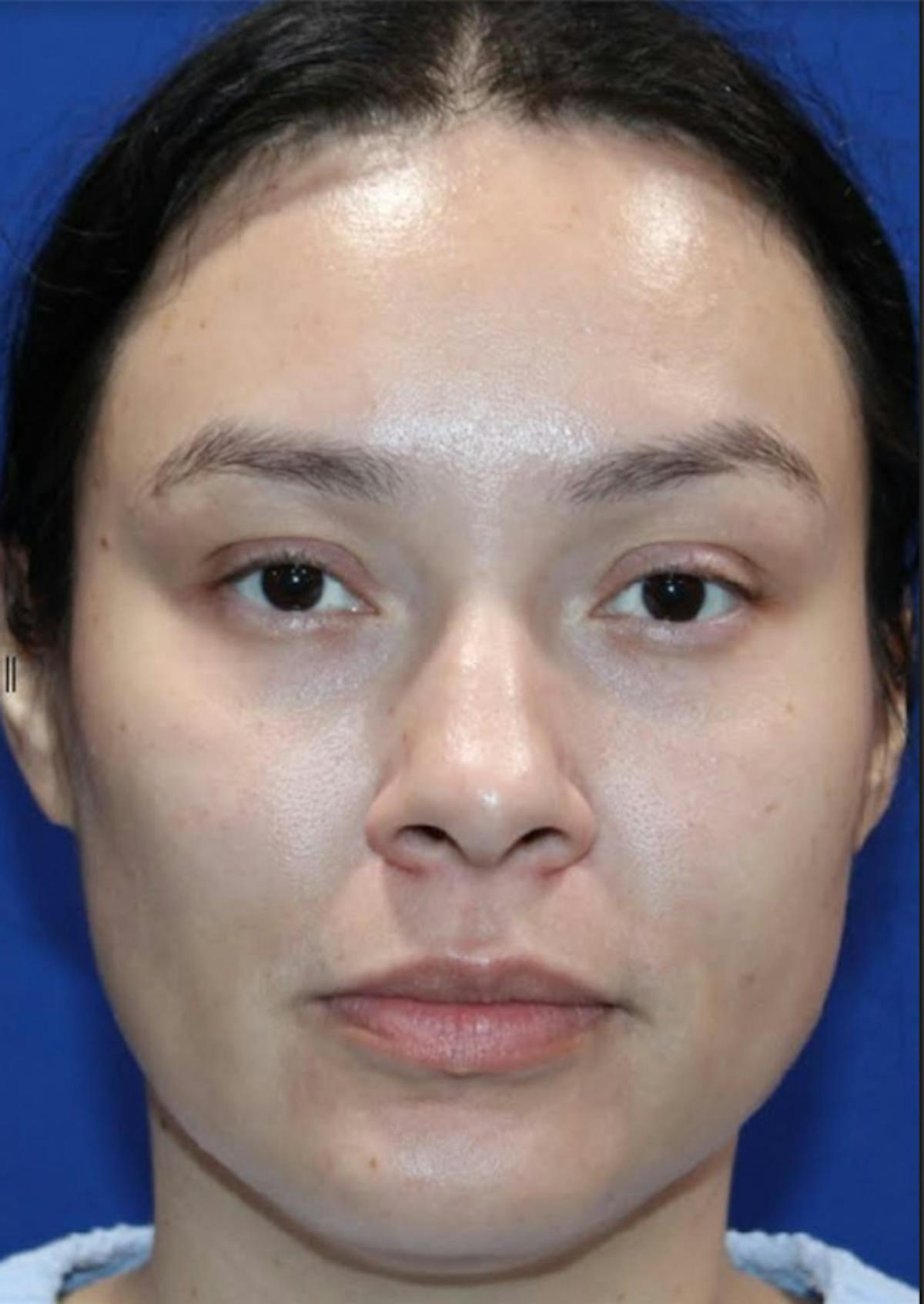 Kyle Cox, MD under-eye filler after — Boulder, CO