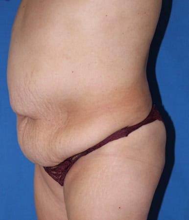 Liposuction before at Iconic Plastic Surgery in Carlsbad, CA