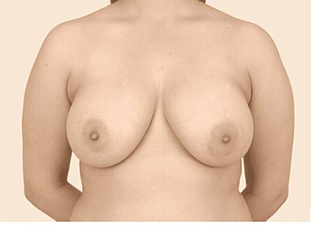 Breast Reduction before at Iconic Plastic Surgery in Carlsbad, CA