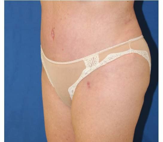 Liposuction after at Iconic Plastic Surgery in Carlsbad, CA