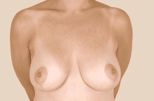 Breast Lift after at Iconic Plastic Surgery in Carlsbad, CA