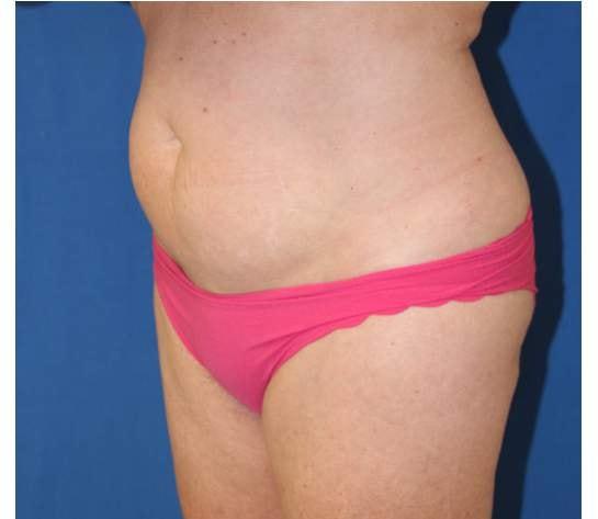 Liposuction before at Iconic Plastic Surgery in Carlsbad, CA