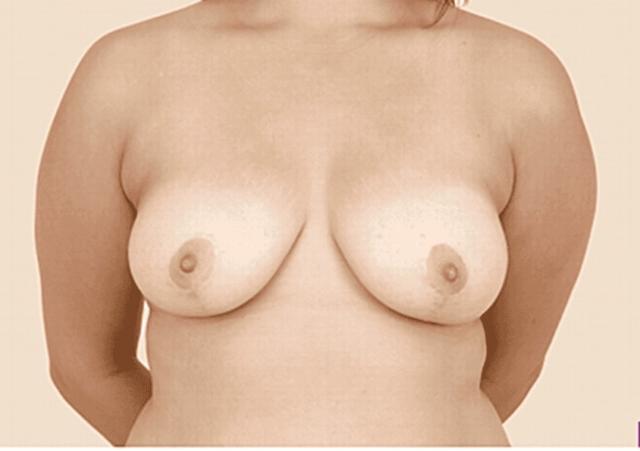 Breast Reduction after at Iconic Plastic Surgery in Carlsbad, CA