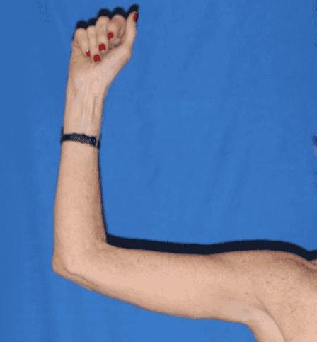 Arm Lift after at Iconic Plastic Surgery in Carlsbad, CA