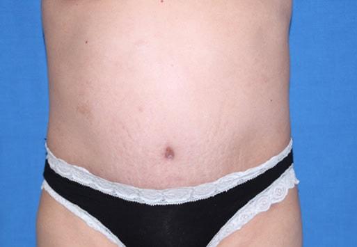 Liposuction after at Iconic Plastic Surgery in Carlsbad, CA