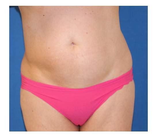 Liposuction before at Iconic Plastic Surgery in Carlsbad, CA