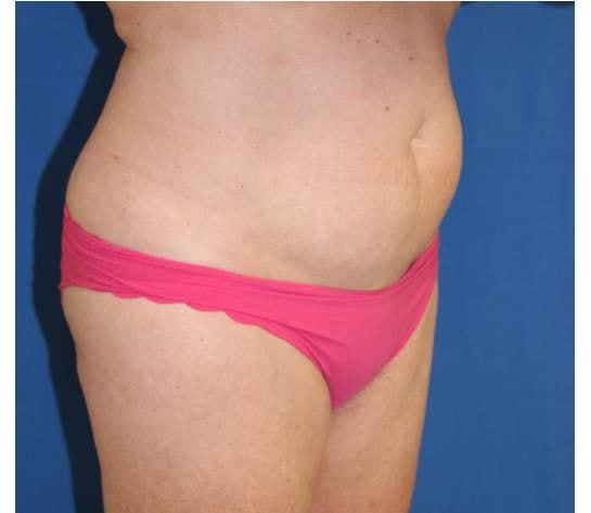 Liposuction before at Iconic Plastic Surgery in Carlsbad, CA
