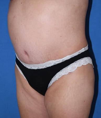 Liposuction after at Iconic Plastic Surgery in Carlsbad, CA