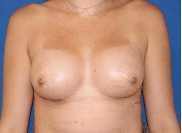 Iconic Plastic Surgery breast augmentation after — Carlsbad, CA