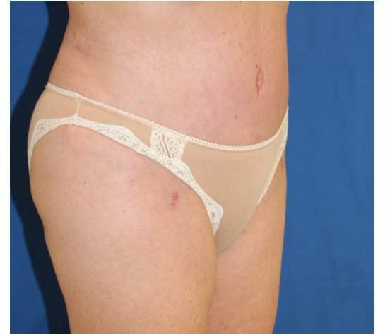 Liposuction after at Iconic Plastic Surgery in Carlsbad, CA