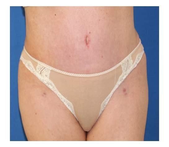 Liposuction after at Iconic Plastic Surgery in Carlsbad, CA