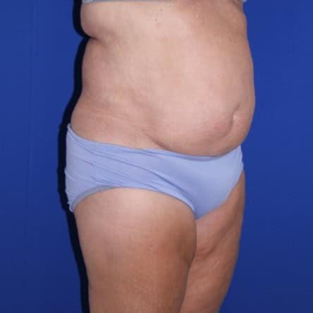 Liposuction before at Iconic Plastic Surgery in Carlsbad, CA