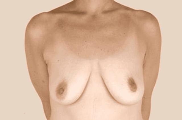 Breast Lift before at Iconic Plastic Surgery in Carlsbad, CA
