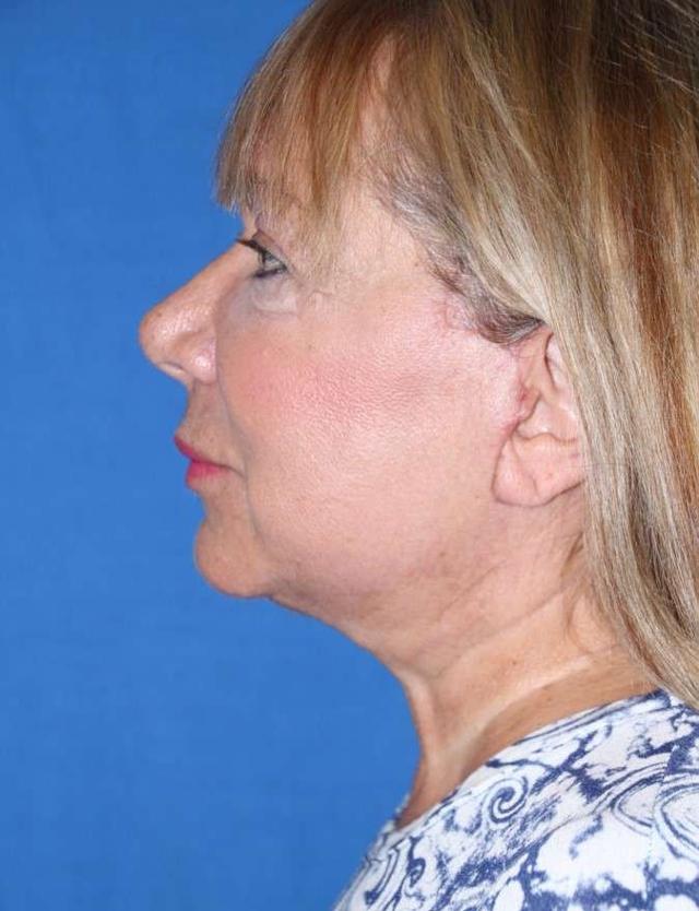 Neck Lift after at Iconic Plastic Surgery in Carlsbad, CA