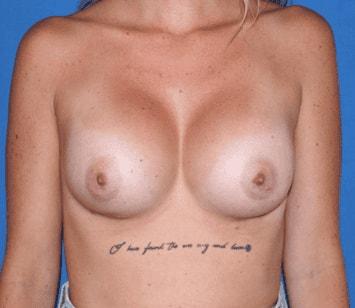 Iconic Plastic Surgery breast augmentation after — Carlsbad, CA