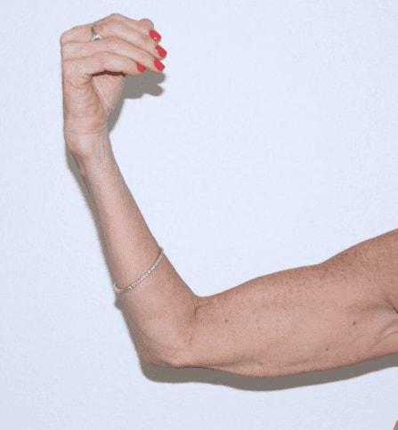 Arm Lift before at Iconic Plastic Surgery in Carlsbad, CA