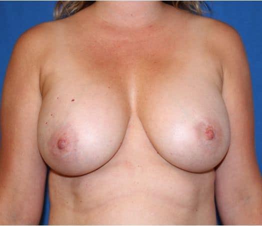 Iconic Plastic Surgery breast augmentation after — Carlsbad, CA