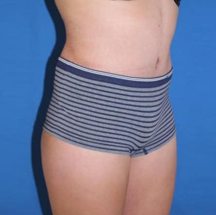 Liposuction after at Iconic Plastic Surgery in Carlsbad, CA