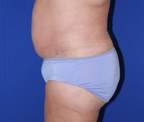 Liposuction before at Iconic Plastic Surgery in Carlsbad, CA