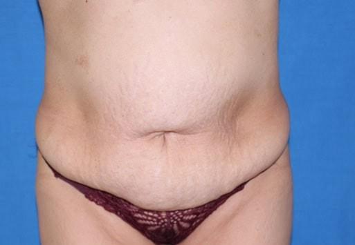 Liposuction before at Iconic Plastic Surgery in Carlsbad, CA