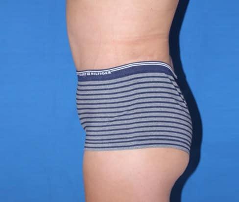 Liposuction after at Iconic Plastic Surgery in Carlsbad, CA