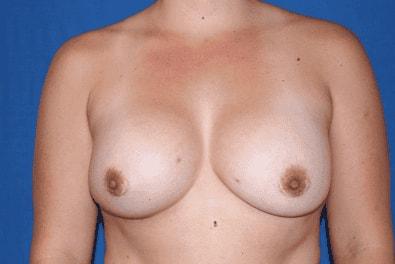 Iconic Plastic Surgery breast augmentation after — Carlsbad, CA