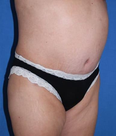 Liposuction after at Iconic Plastic Surgery in Carlsbad, CA