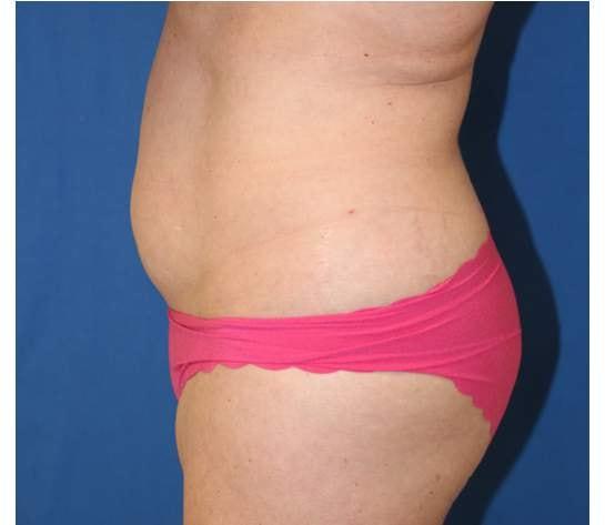Liposuction before at Iconic Plastic Surgery in Carlsbad, CA