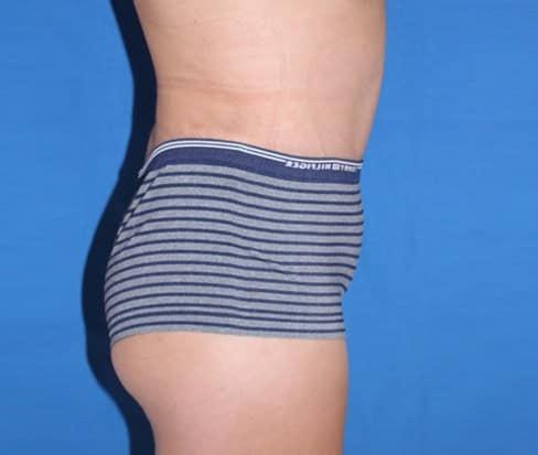 Liposuction after at Iconic Plastic Surgery in Carlsbad, CA