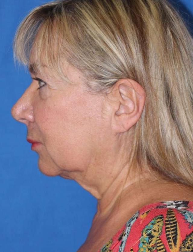Neck Lift before at Iconic Plastic Surgery in Carlsbad, CA