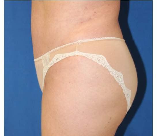 Liposuction after at Iconic Plastic Surgery in Carlsbad, CA