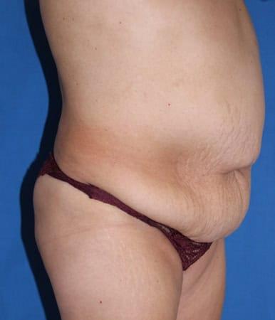 Liposuction before at Iconic Plastic Surgery in Carlsbad, CA